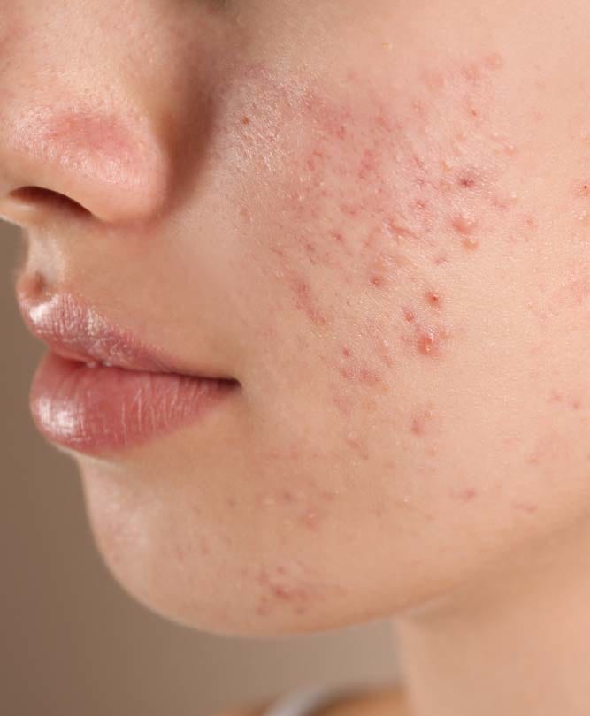 Acne - Skin Condition Refresh