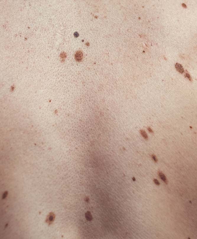 Skin Lesions - Skin Condition Refresh