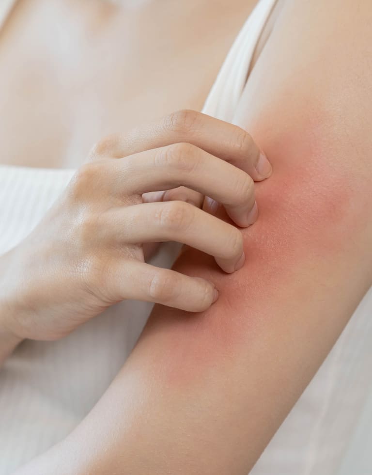 Refresh Medispa - About Eczema & Psoriasis