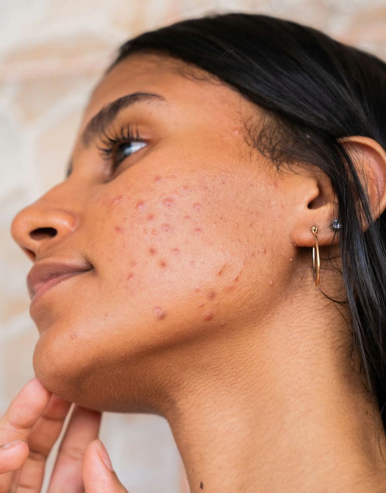 Refresh Medispa - About Acne Treatment What We Assess