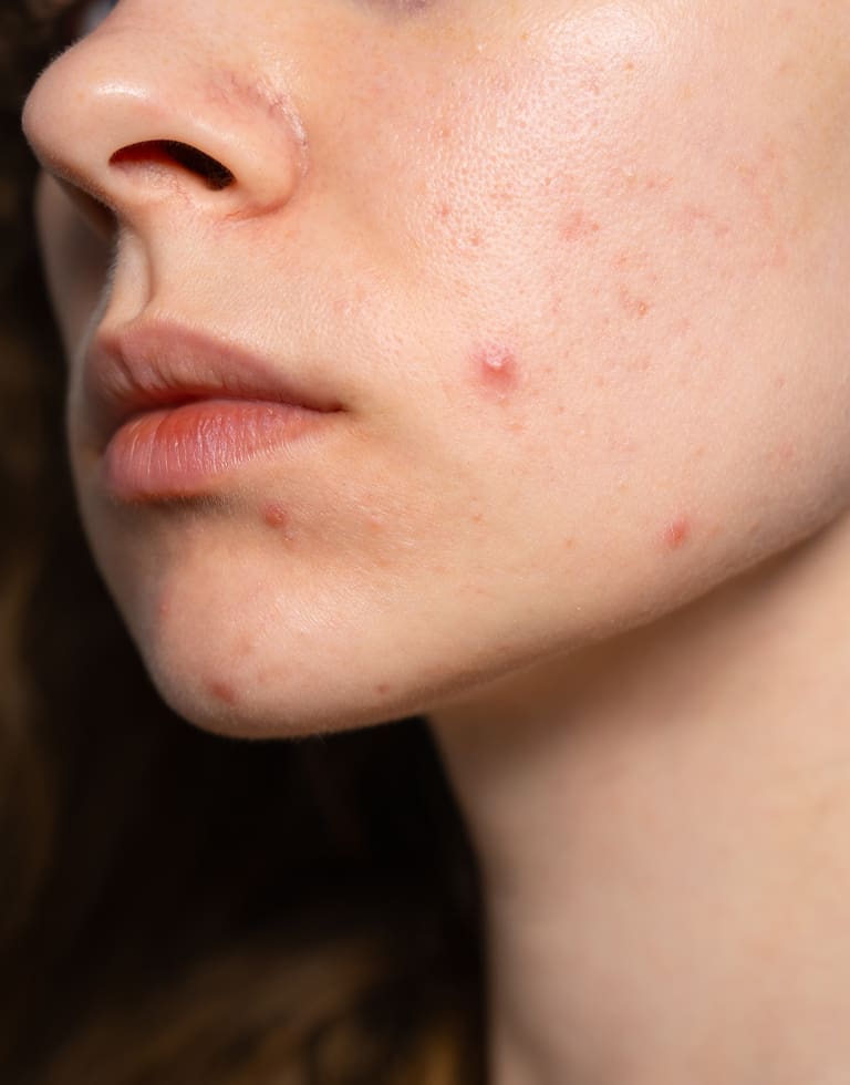 Refresh Medispa - About Acne Treatment What We Assess