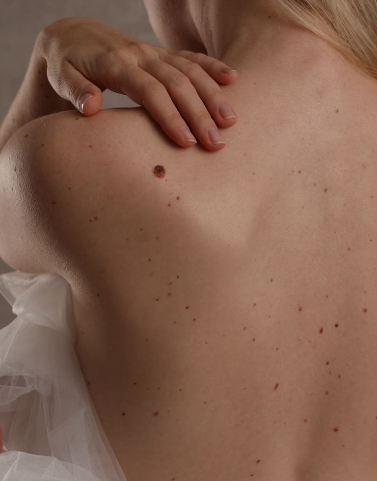 Refresh Medispa - Mole Checks & Skin Lesion Review Benefits