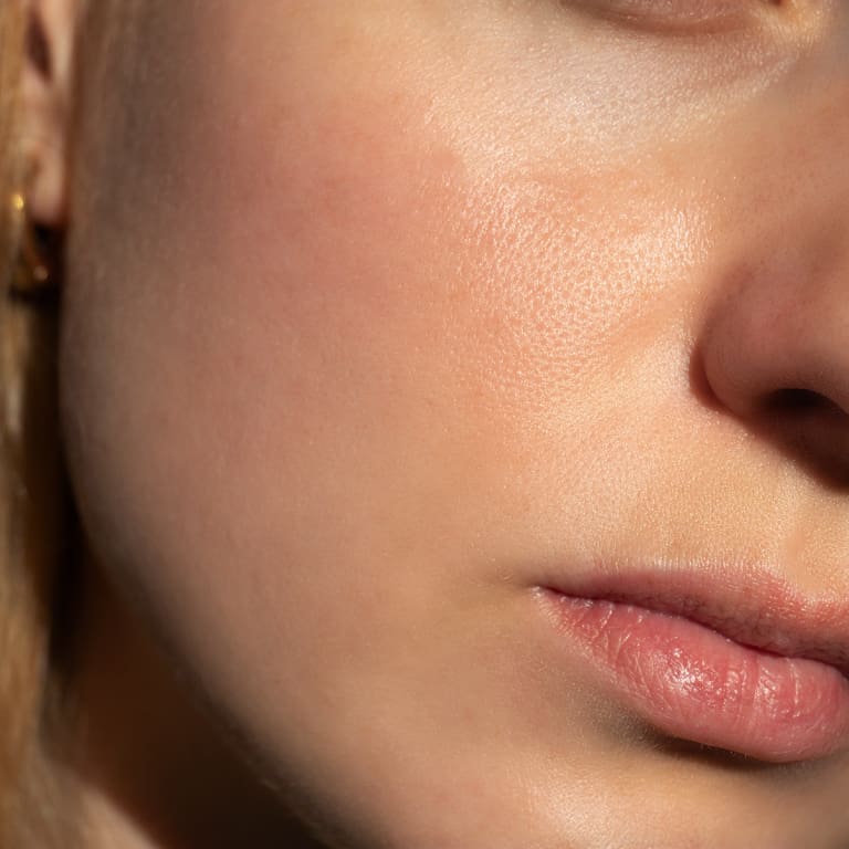 Refresh-Medispa-Rosacea-Treatment-Main